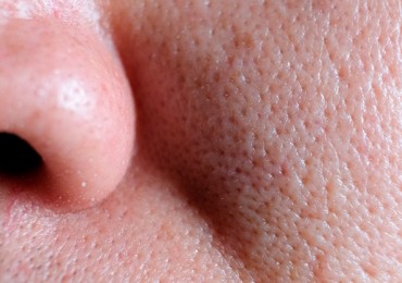 ¿Es posible eliminar los poros dilatados?